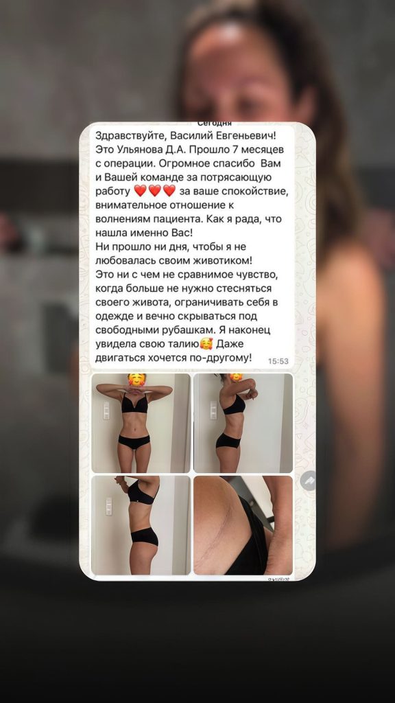 Отзыв после абдоминопластики. Хирург Никитин В.Е.