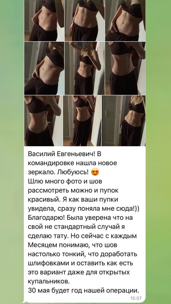 Отзыв после вертикальной абдоминопластики. Хирург Никитин Василий Евгеньевич
