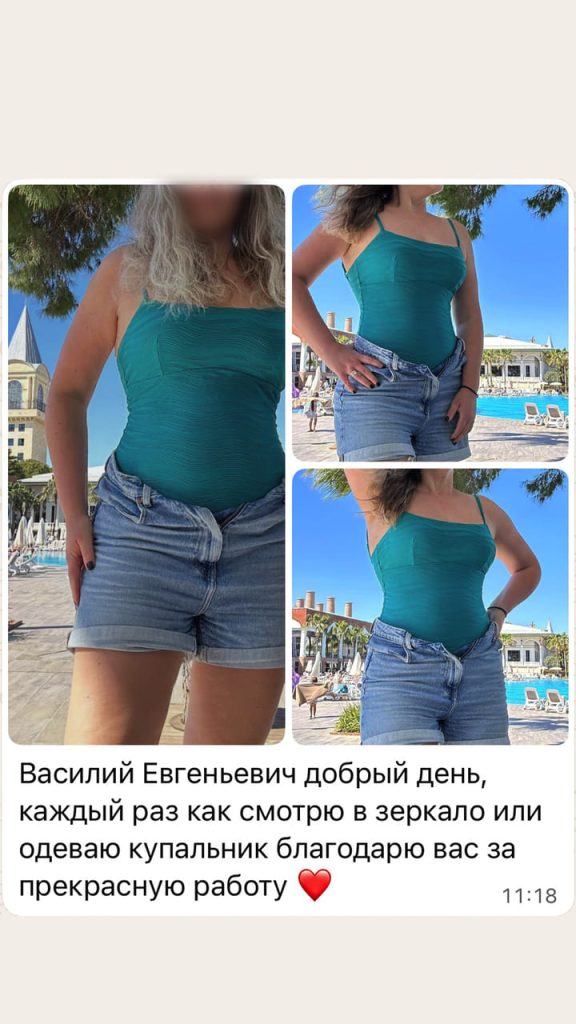Фото отзыв. Бодилифт с липосакцией. Хирург Никитин В.Е.