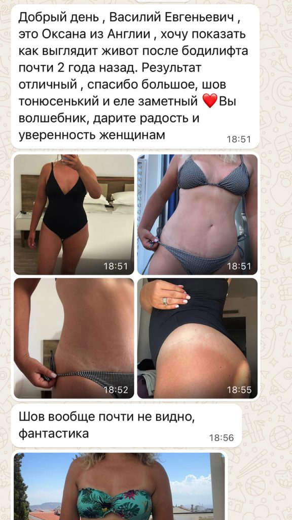 Отзыв пациентки. Бодилифт с липосакцией. Хирург Никитин В.Е.